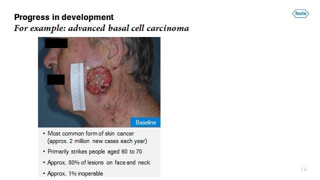 Address by Severin Schwan Page 12/16 Basal cell carcinoma is the most common form of skin cancer in Europe, the United States and Australia.
