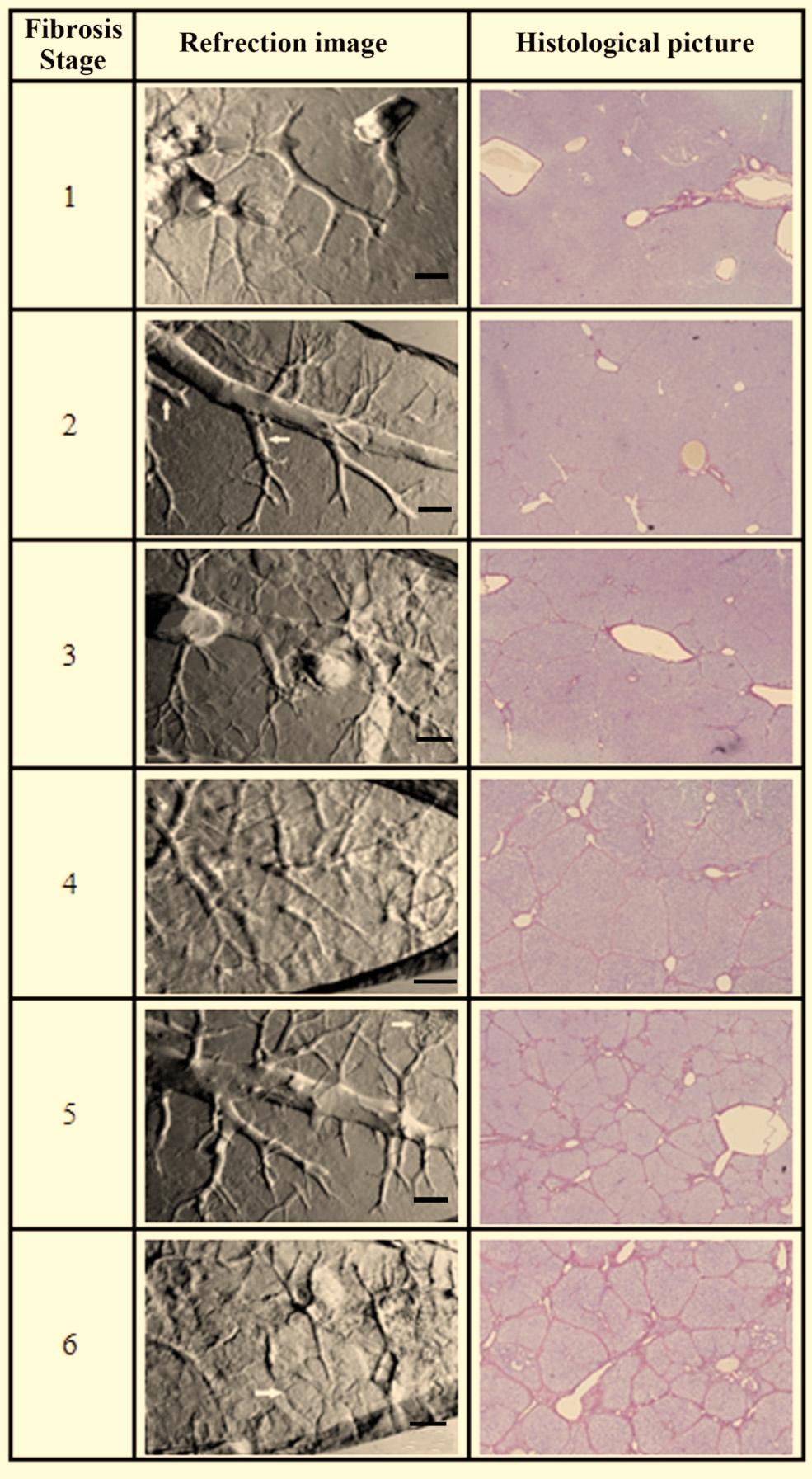 22 The Open Medical Informatics Journal, 2011, Volume 5 Zhang and Luo Fig. (3). The refraction images of hepatic fibrosis samples and the corresponding histological images from stage one to six.