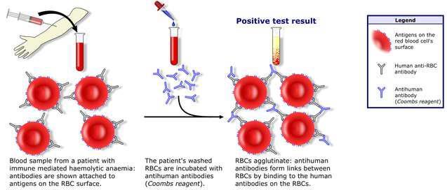 (a) Direct Coomb's Test When antibodies bind to erythrocytes, they do not always result in agglutination.