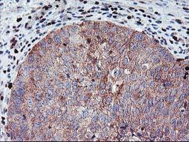 Carcinoma of Human bladder tissue using anti-mef2c mouse monoclonal antibody.