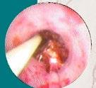 S pine ENT Stenosis of the nose is treated by trimming of turbinates and the nasal