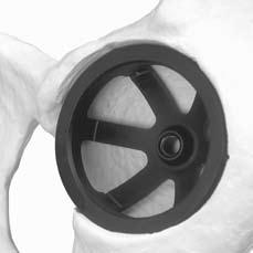 Minimize the amount of bone reaming, performing only that necessary to achieve creation of an adequate hemispherical cavity for support of the Revision Shell.