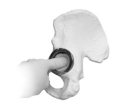 The neutral liner provides an option for standard acetabular reconstruction, while the oblique liner offers additional joint stability with the
