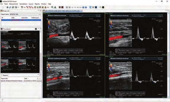 Vascular Viewing and Reporting Reporting templates include Aorta, Venous,