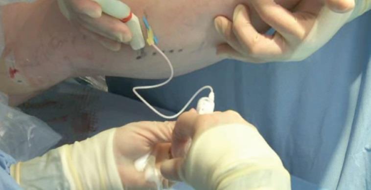 Microfoam Chemical Ablation Therapy with PEM Catheter based endovascular procedure performed