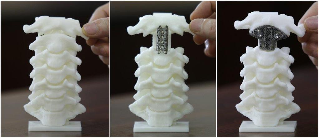 Story III: 3D-printed Vertebra (σπονδυλος) The Problem: A rare bone cancer can grow in the vertebra A normal spine model The traditional Titanium Tube 3D-printed artificial Vertebra Vertebra made out