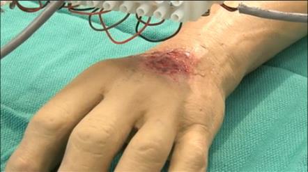 3D Print Skin Cells Onto Burn Wounds 3d scanning the wound