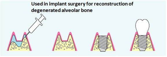 Not many surgeons in the US use bone substitute material when conducting alveolar bone reconstruction surgery as part of implant treatment.