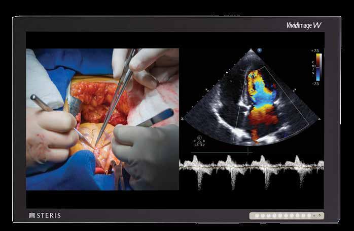 Truly Connected for Better Patient Outcomes Compare and Contrast Video at a Glance Experience enhanced visualization that allows OR teams to view video from multiple sources side-by-side on one