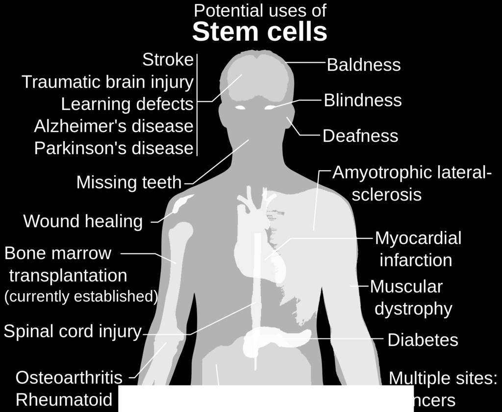 13 Figure 6: Potential use of stem cells as treatment in the human body: In this paper, I look at the various possibilities of stem cell treatment in some acute musculoskeletal (orthopaedic)