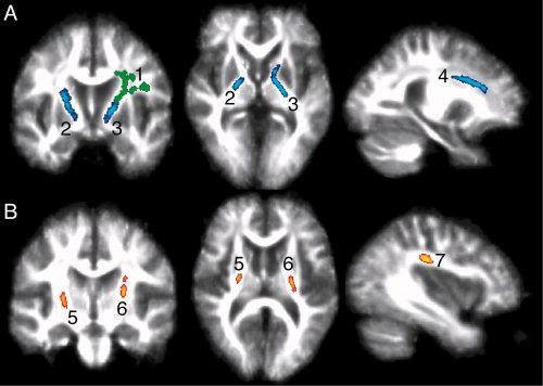 Altered fractional anisotropy in white matter tracts after stroke Patients (>6 months