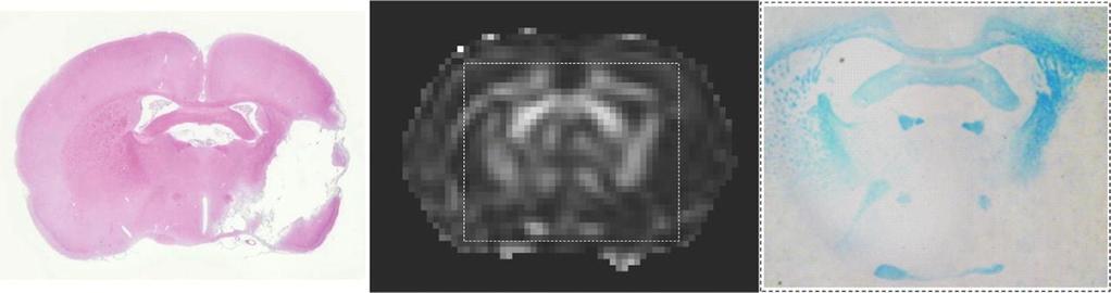 Degeneration and remodeling of perilesional white matter after stroke Tract-based spatial statistics of FA maps: Stroke (day 70; n=5) vs.