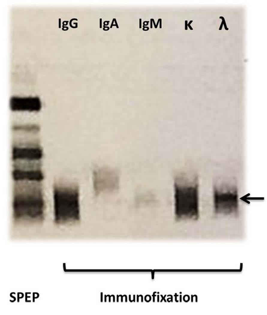 Figure 5. On the left, a serum protein electrophoresis (SPEP) of a patient with a monoclonal band in the gamma region is shown.