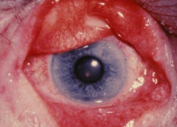 end-stage Age-related macular