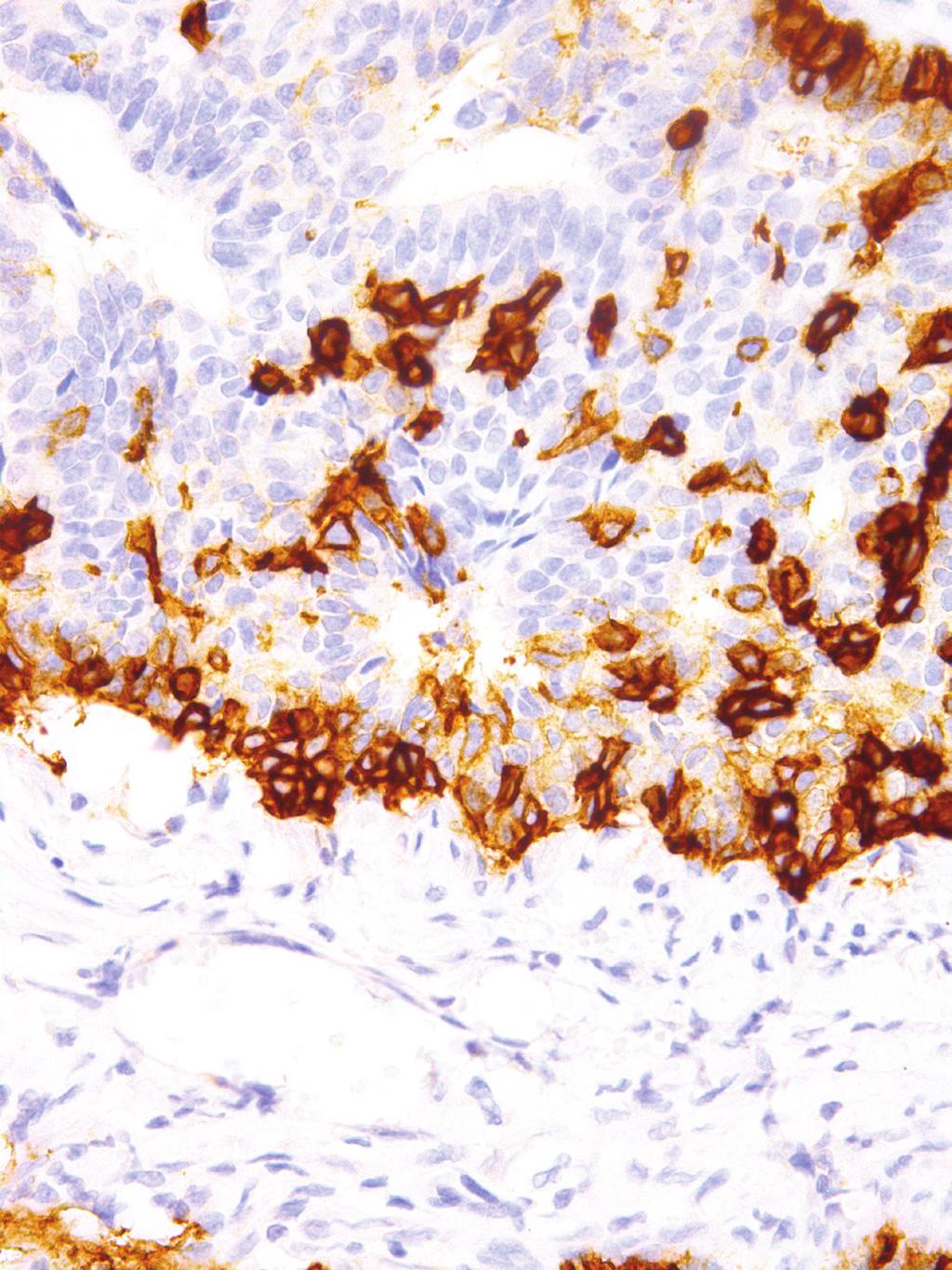 GeneAb TM Nerve Growth Factor Receptor (NGFR) Clone: IHC637 Source: Mouse Monoclonal Positive Control: Breast GeneAb TM Nerve Growth Factor Receptor (NGFR) (IHC637) on Cervix Product Information