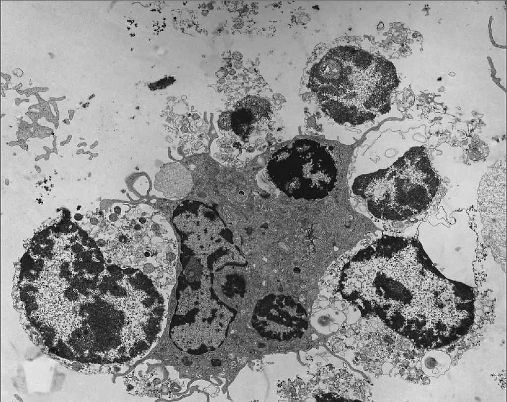 * N * Fig. 2. Electron micrograph showing a DC phagocytosing apoptotic cells.