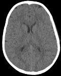 Brain CT 1 kv: better gray/white differentiation CTDI: dose and noise balanced Fixed ma: not sensitive to