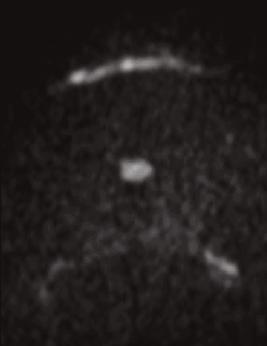 12 Clinical Whole-body Imaging 7A Figure 7: 27-year-old patient with Hughes-Stovinson-Syndrom and M.