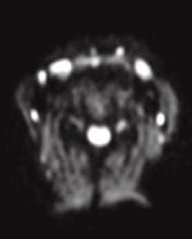the 3T MAGNETOM Vida. 7B 8A 8B 8C Figure 8: 57-year-old patient with parotid cancer.