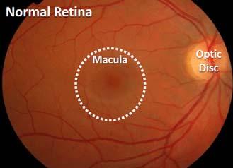 Significant unmet need in choroideremia (CHM) Rare, degenerative disease that leads to blindness; no treatment options Inherited X-linked monogenic retinal disease o Affects ~ 1:50,000,