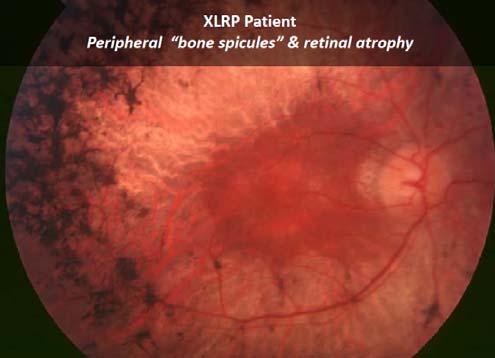 Opportunity in X-linked retinitis pigmentosa (XLRP) Progressive photoreceptor degeneration that leads to blindness; no treatment options Rare X-linked monogenic retinal disease o Affects ~ 1:40,000,