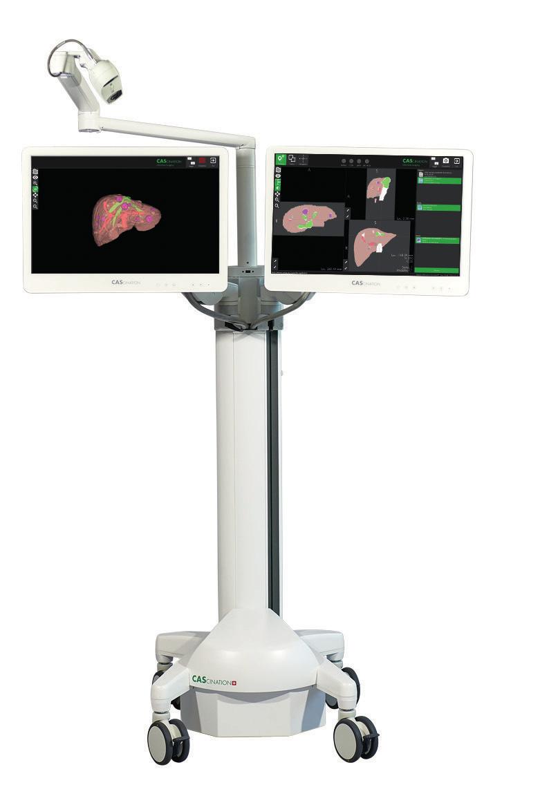 CLINICAL BENEFITS Technical accuracy, intraoperative efficacy, and safety Realtime 3D vascular orientation Improves accuracy of both ablation and resection Accurate multiple needle placement Allows