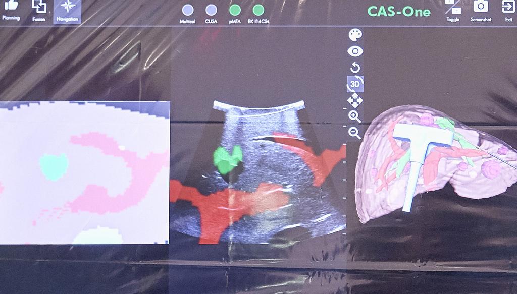 USE CT, ULTRASOUND AND 3D IMAGING FOR BETTER INTRA-OPERATIVE ORIENTATION See exactly what you need to see during surgery. Having all available patient information at your fingertips is crucial.