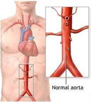 Example 2: Tissue Engineering of the Abdominal Aorta Allogeneic Aortic Transplantation in Rat Model after Decellularisation Morticelli L¹, Katsimpoulas M¹, Michalopoulos E, Gontika I, Chaniotakis I,