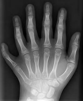 (d) Polydactylism is an unusual feature in the hand. Like Huntington s this feature is also inherited by a dominant allele.