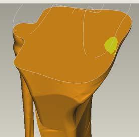most critical contact point between the tibia