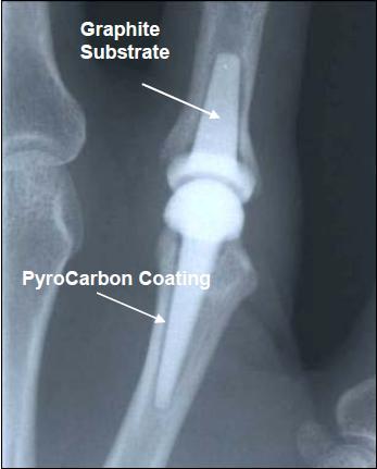 bone than any other metal implant material Strength: Three to four times stronger than natural bone Imaging: Makes use