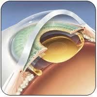 and intraocular lenses Tissue bulking Soft solid