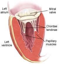 Stroke mitigation Myocardial infarction occurs when part of heart dies Due to blockage of blood flow to