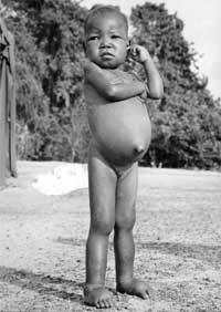 Kwashiorkor Native word in Ghana meaning displaced child.