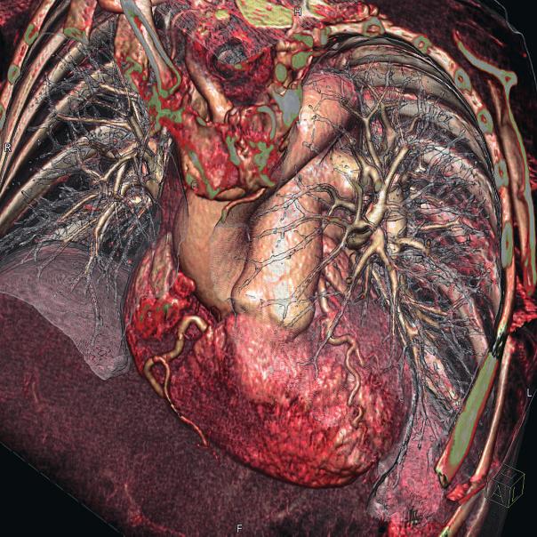 Middle: Accurate display of pulmonary arteries, rule out pulmonary embolism.