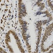human kidney cancer tissue using Histone H3R8 Dimethyl Symmetric (H3R8me2s) Polyclonal