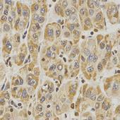 human liver cancer tissue using Histone H3R8 Dimethyl Symmetric (H3R8me2s) Polyclonal