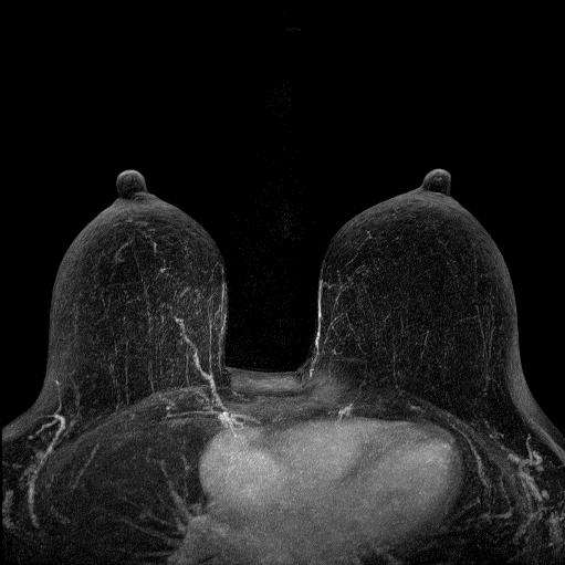3D digital subtraction post-contrast MRI of Breasts In Ayios Therissos