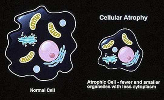 Tissues Examples of cell responses to injury Atrophy decrease in size/number (from apoptosis)