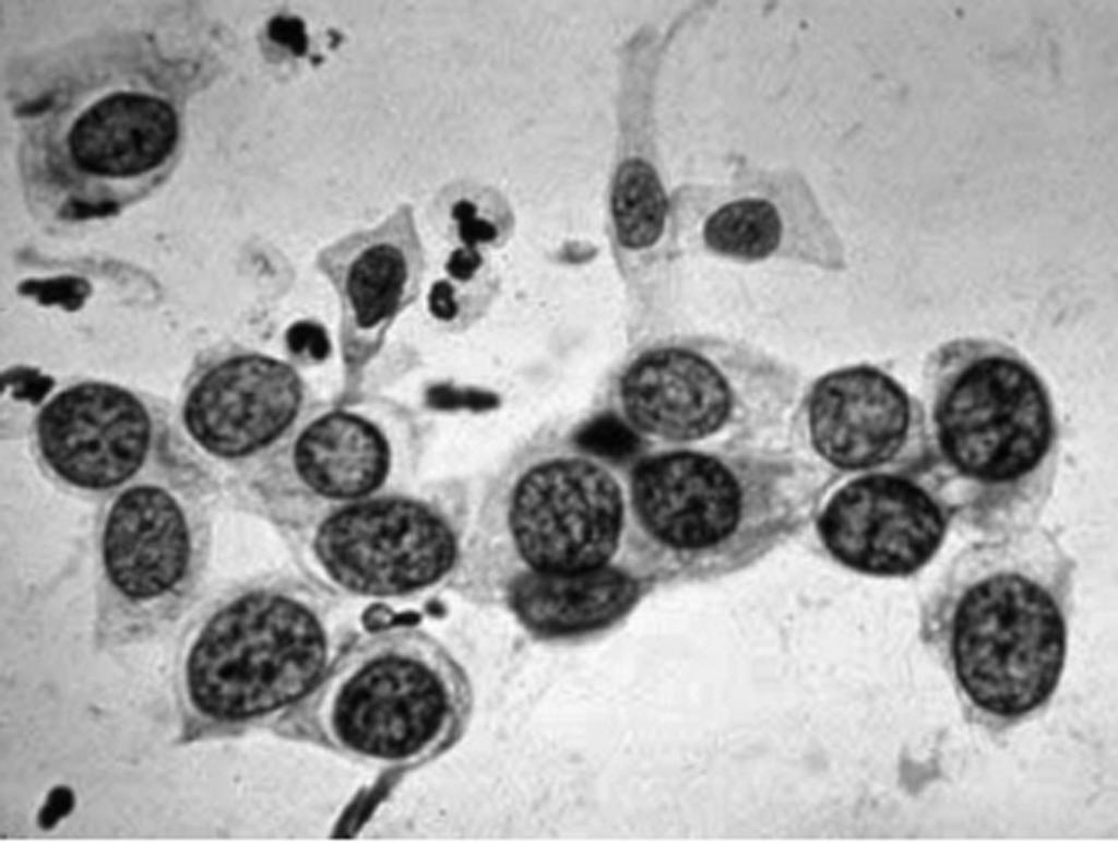 5 (g) Fig. 1.4 shows cells that were taken from the cervix of another woman during a routine smear test. Fig. 1.4 (i) Use Fig. 1.3 and Fig. 1.4 to suggest a suitable conclusion or diagnosis that a pathology technician might make about the cells in Fig.