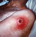 Challenge: Smallpox Vaccine Safety Problem: Smallpox vaccines can cause rare, fatal complications that need treatment with antiserum (VIG), but existing supplies inadequate (both amount and quality).