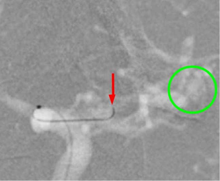 Fig. 1. Augmented Fluoroscopy (AF) case. (left) Original fluoroscopy image ; (right) AF view.