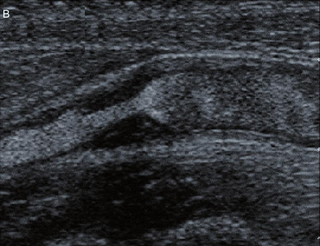 With the recent advent of UltraFast TM ultrasound imaging [1], the performance paradigm of Doppler imaging mode is changing.