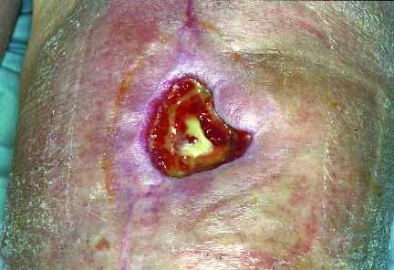 ulcer. Fig.