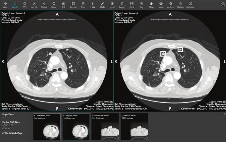 EXAMPLE APPLICATION One application of deep learning is for performing lung nodule detection.