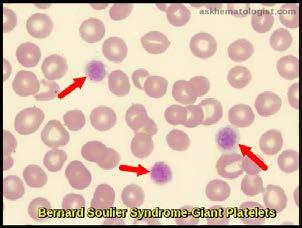 Platelet morphology Large platelets often