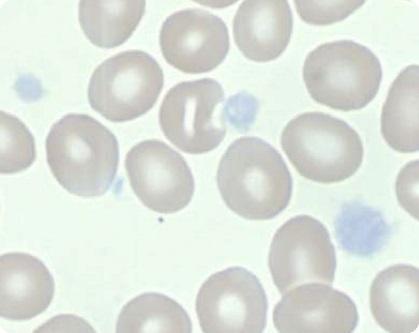 platelets may look abnormal Gray platelet