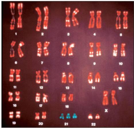 The figure at right is a... Autosomal Mutations of Number...Karyotype This is a female because there are 2 X chromosomes.