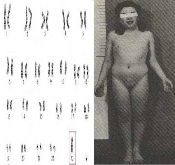Sex Chromosome Mutations of Number Female Male This is a female because she does not