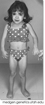 This individual has Turner s Syndrome, caused by nondisjunction and monosomy of the